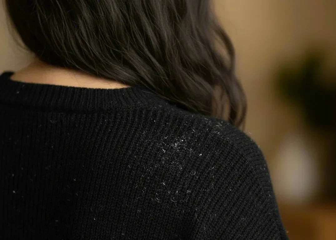 Fair-skinned woman with black wavy hair has dandruff on her sweater from her itchy scalp, in front of a brown background.
