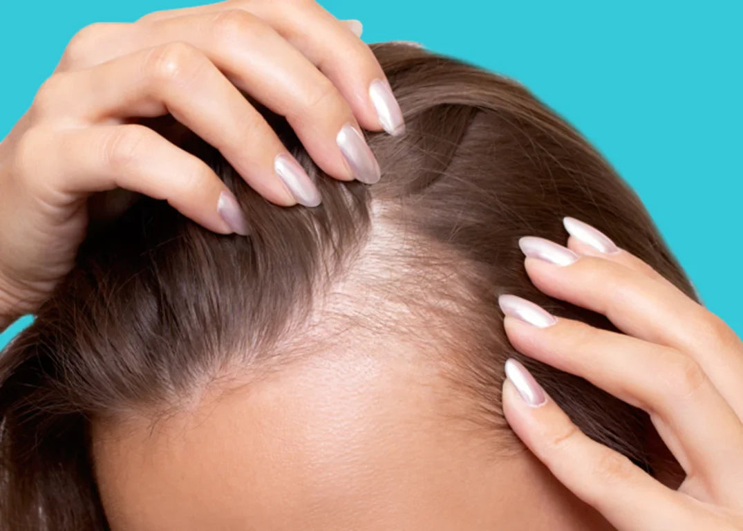 A woman with fair skin and light brown thinning hair holds it apart at the roots in front of a light blue background.